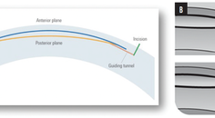 The CLEAR Advantage for Corneal Aberrations