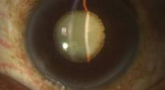 Is Lens Surgery The New LASIK