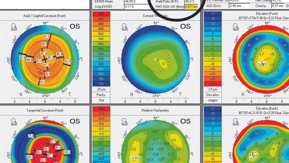 Corneal Changes After IOL Exchange