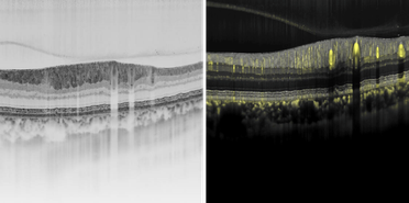 Heidelberg Engineering Presents Various Scientific Innovations at ARVO image