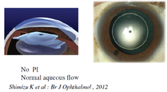 EVO Visian ICL 10 Years of Follow Up