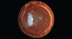 The YAG Capsulotomy The Final Hurdle to a Premium Visual Outcome