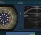 The Complete Refractive Cataract Surgery Package