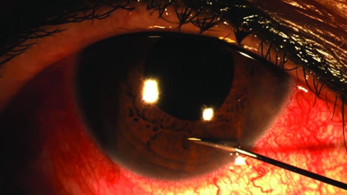 Leaky Anterior Chamber Paracentesis