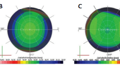 Optimization of Surgical Treatments in the Cornea