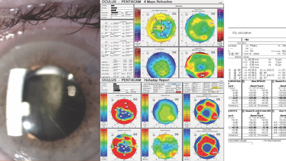 Comorbid Cataract and Macular Hole