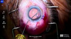 Prolene Suture Fixation of Capsular Tension Segment During Lens Exchange thumbnail