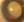 Figure 3. A hard cataract with massive lenticular subluxation.