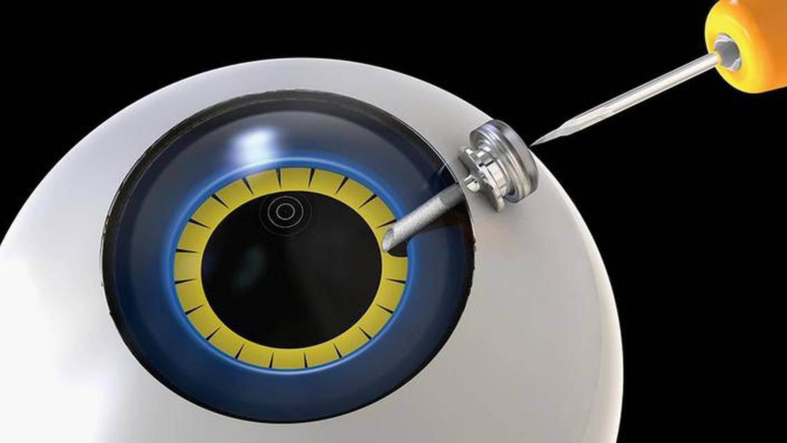 Maintaining Proper Anterior Chamber Pressure