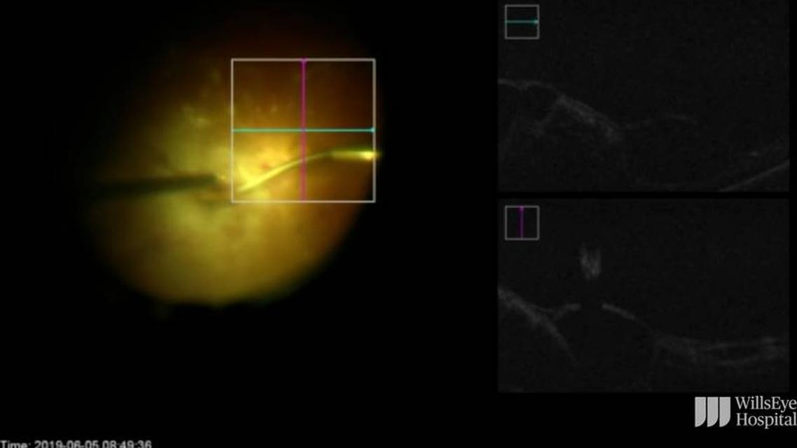Creating Space With Flat Adherent Tractional Membranes thumbnail