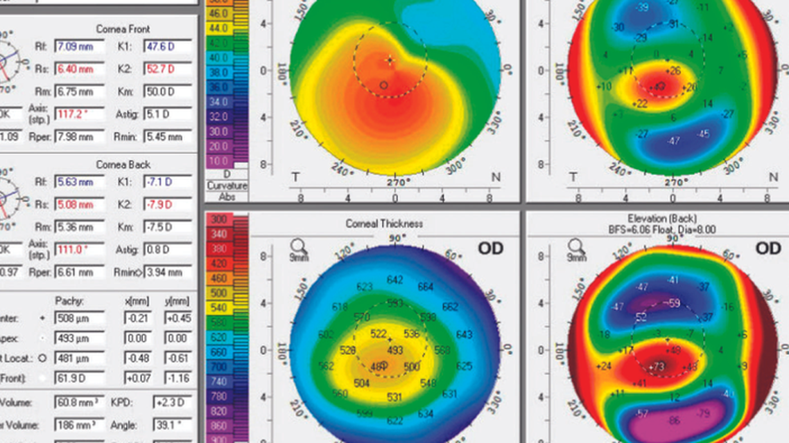Keratoconus and Contact Lens Intolerance