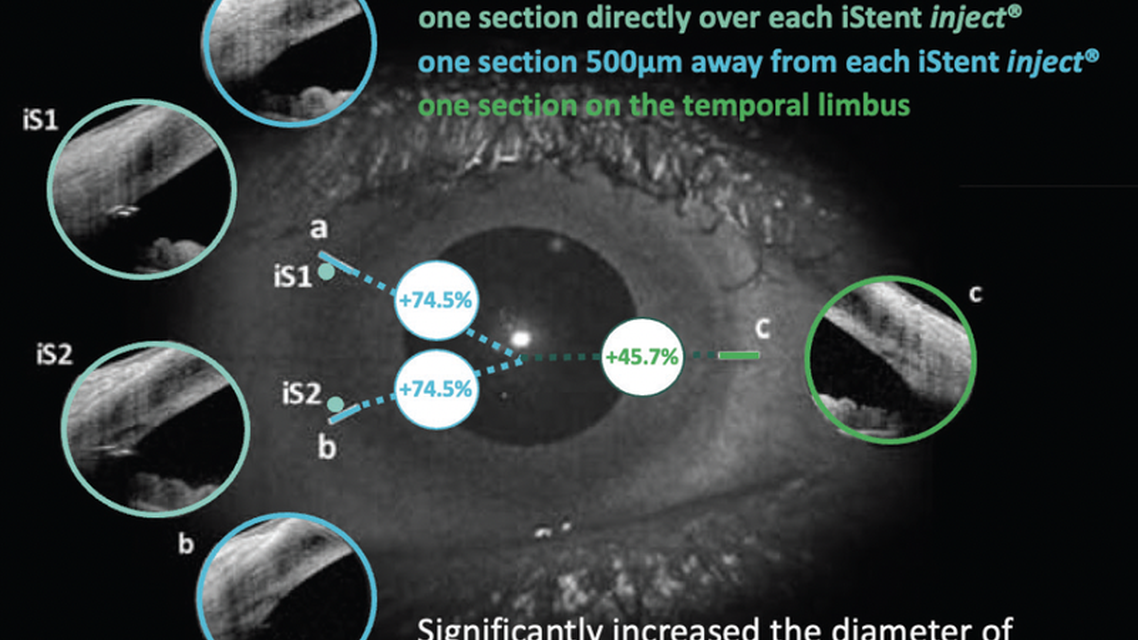 Trabecular Micro Bypass for the Treatment of Glaucoma