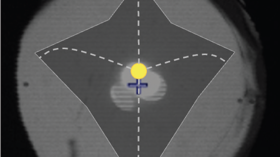 Overcoming the Last Barrier to Good Visual Outcomes