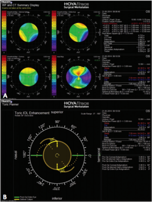 Advancing Cataract Surgery With Diagnostic Technologies