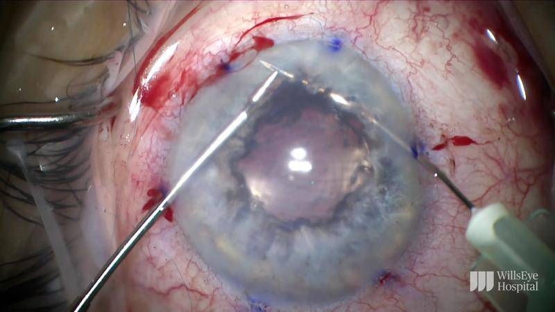 TASS After Cataract Surgery thumbnail