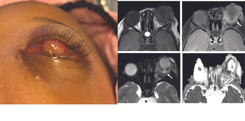 Endophthalmitis in a Patient With Presumed Axenfeld Rieger Syndrome