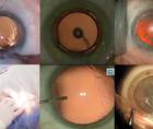 Routine Surgery Using the Femtosecond Laser