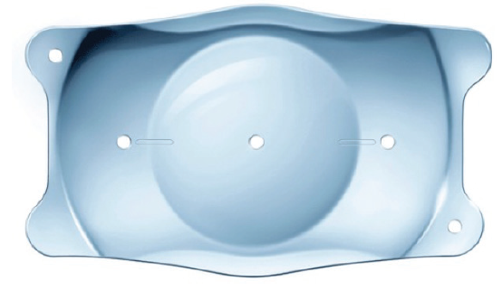 Proven Clinical Outcomes With the EVO Visian Toric ICL