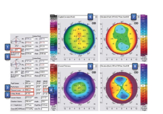 A 12-Point Algorithm to Master Corneal Tomography