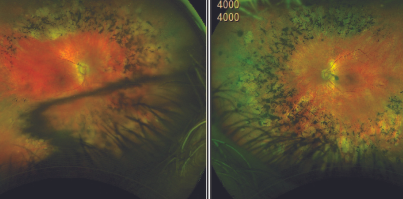 IOL Subluxation in the Presence of Retinal Disease