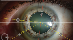 The Role of Iris Fingerprinting in Toric IOL Alignment