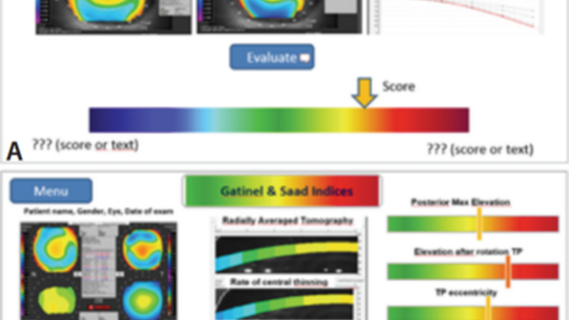 Detecting Early Keratoconus and Avoiding Iatrogenic Ectasia The SCORE Analyzer