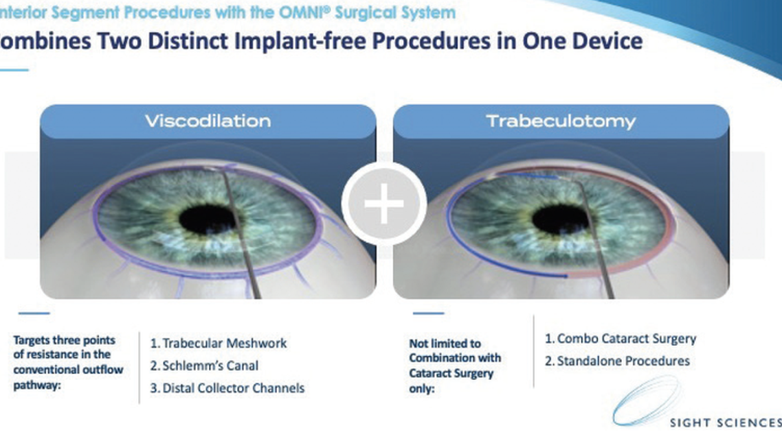 Surgery of the Conventional Outflow Pathway