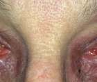 Early Intervention Is Best for Patients With Glaucoma
