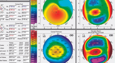 Keratoconus and Contact Lens Intolerance