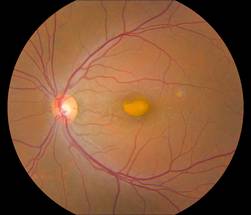 High-Tech Imaging Reveals Details About Rare Eye Disorder image