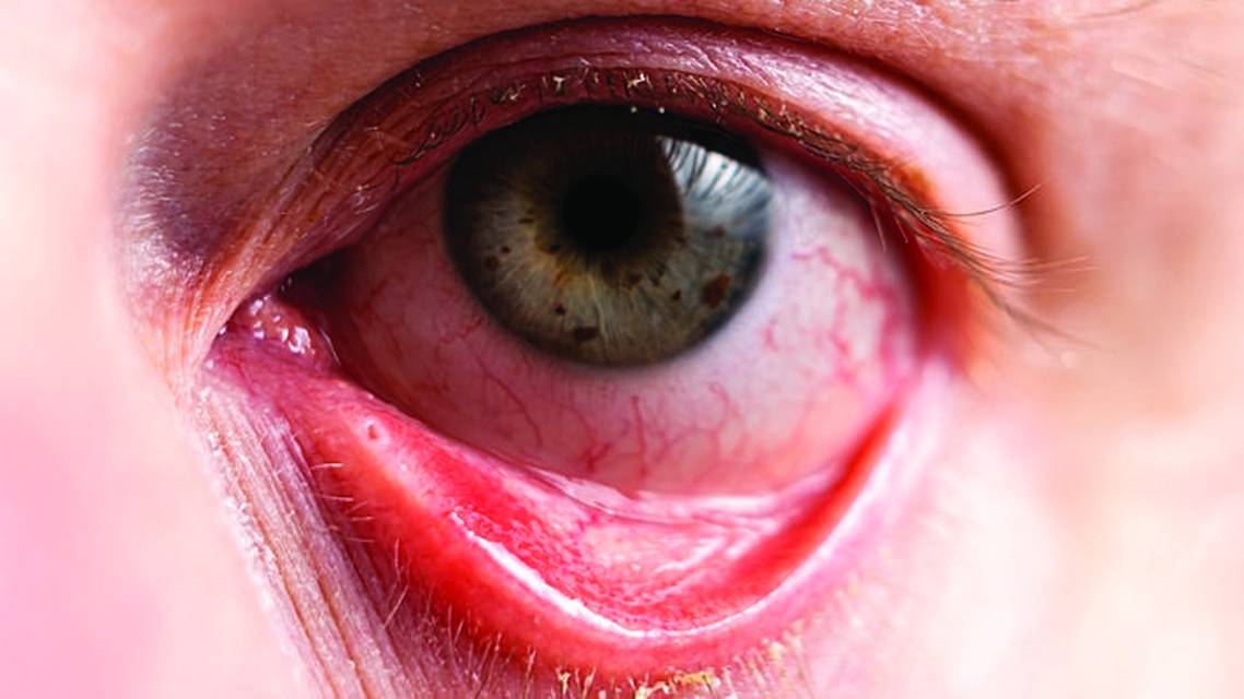 Approaches to Dry Eye Disease