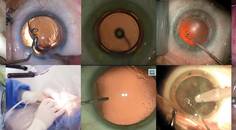 Routine Surgery Using the Femtosecond Laser