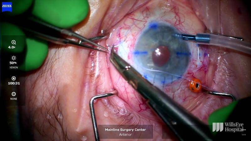 Repeat DSEK Combined With IOL Removal and Secondary IOL With Scleral Fixation thumbnail