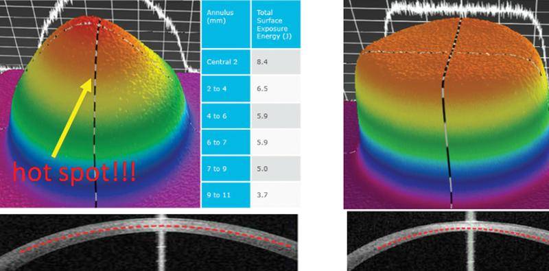 CXL Alone Versus in Combination With the STARE X Protocol