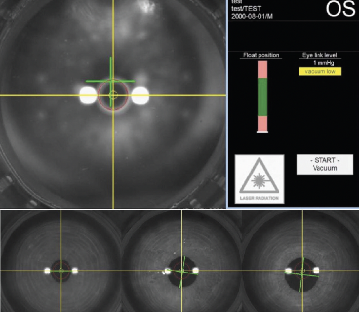 ATOS and SmartSight Current Trends and Procedural Volume