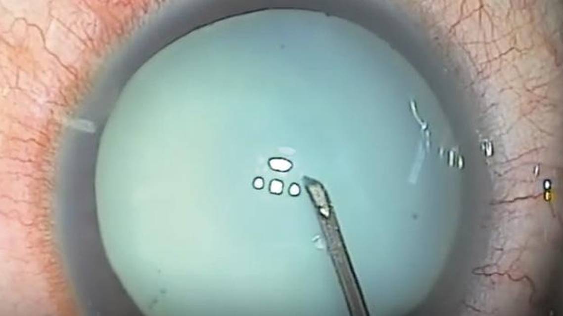 I Dont Have a Femtosecond Laser What Strategies Work Best for a White Cataract
