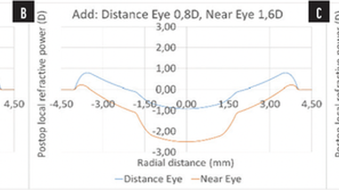 PresbyMAX Monocular