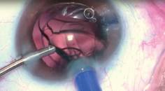 LACS and the FEMTIS IOL Best Practices With the CapsuLaser