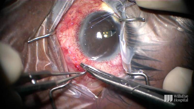 Minimizing Risks During Tube Shunt Surgery in SturgeWeber Syndrome thumbnail