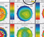 Cataracts After Monovision LASIK