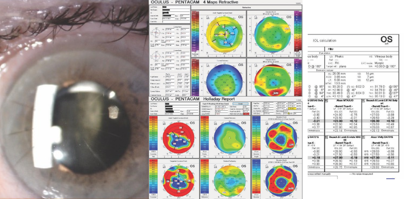 Comorbid Cataract and Macular Hole