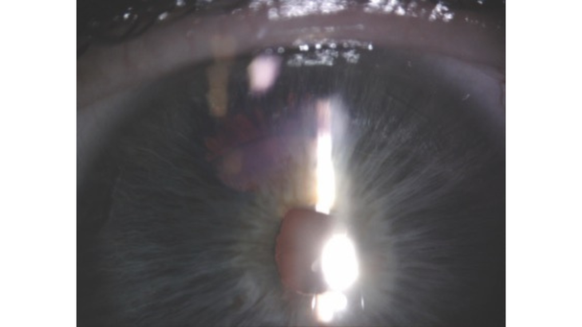 Transillumination Defects After the Implantation of a One Piece IOL in the Bag