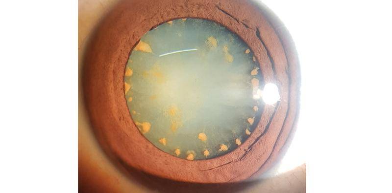 Ocular Siderosis Without a Detectable Intraocular Foreign Body