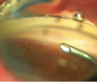 Early Experience With the OMNI Surgical System