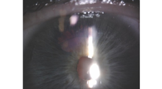 Transillumination Defects After the Implantation of a One Piece IOL in the Bag