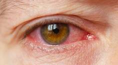 Aggressive Recurrent Inflammation After LASIK