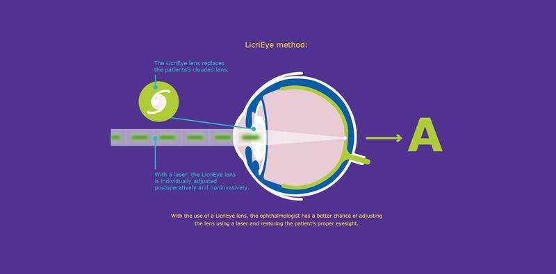 Making Room for Future IOL Technologies