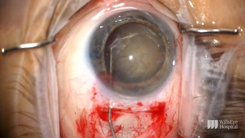Management of Brunescent Cataract With ECCE thumbnail