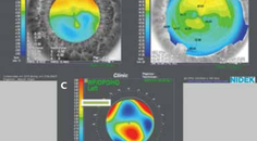 What Makes a Good Refractive Surgeon