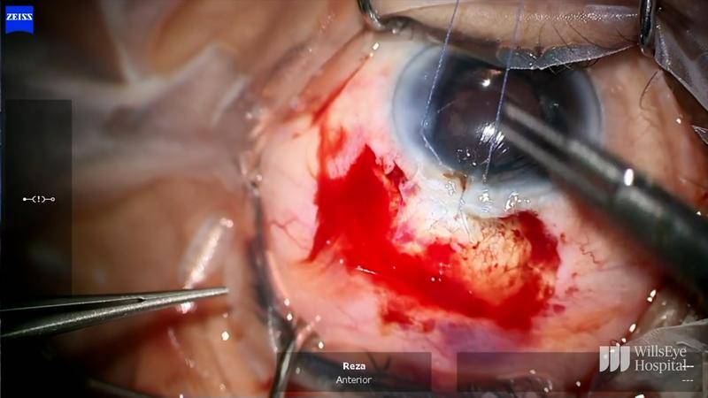 Phacoemulsification Bleb Excision and Tube Shunt Surgery thumbnail